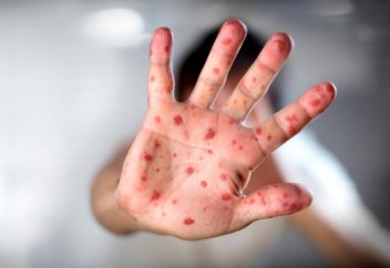 Как распознать корь и чем она опасна