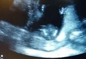 АҚШ-та әйел адам ағзасын өзге балаларға беру үшін емделмейтін ауруға шалдыққан қызын дүниеге әкелмекші