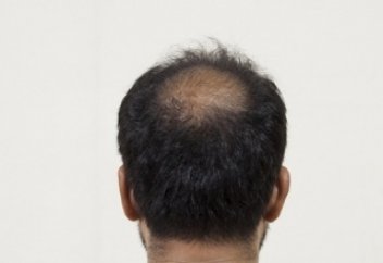 Облысение: коллекция заблуждений