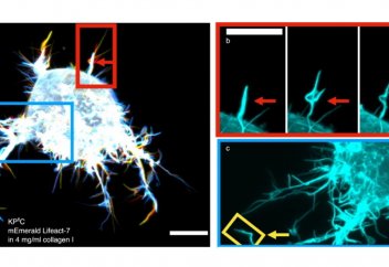 Қатерлі ісік жасушасының қармауыштары организмге енуіне көмектеседі