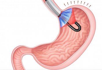 Асқазанға орнатылатын лазерлі импалант семіздікпен күресуге көмектеседі