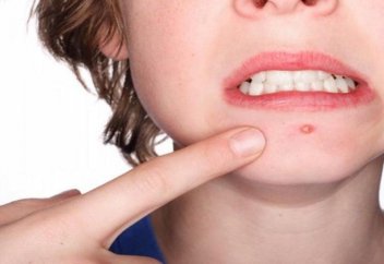 Сыздауықты емдеу жолдары