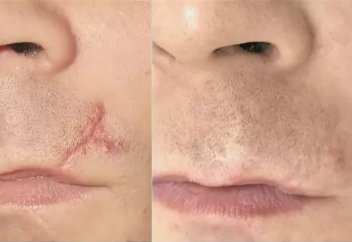 Тілінген, жарақат алған, күйген терінің қалпына келу процесі