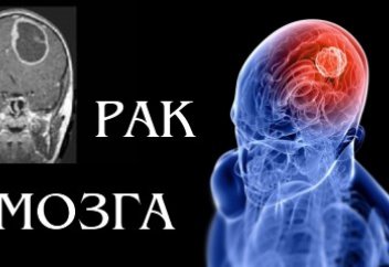 Рак мозга можно предсказать за пять лет до его проявления
