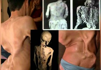 «Тас адамы» синдромымен күресуге арналған дәрі табылды