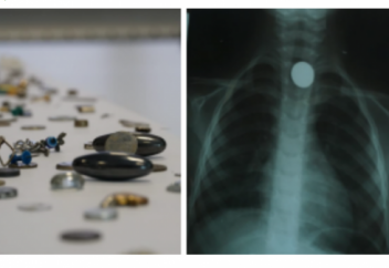 Бала батарея жұтып қойды: қалай көмектесу керек?