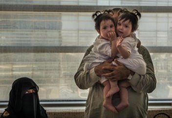 Сиам егіздері сәтті ажыратылды (ФОТО)