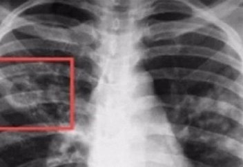 Туберкулезге шалдықпас үшін нені ескеру қажет?