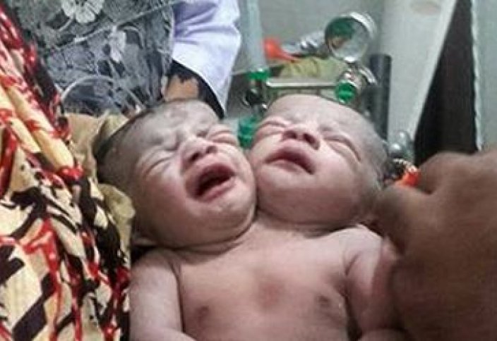 Екі басты бала дүниеге келді