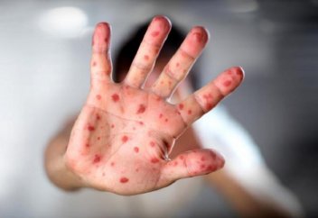 Өткен жылы әлемде қызылшадан қанша адам өлді