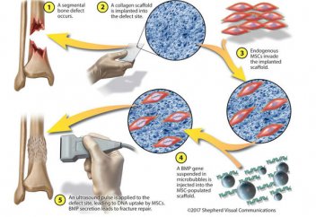 Найден способ лечить переломы без гипса (видео)