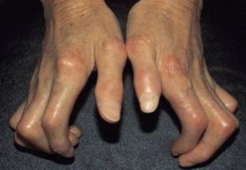 Биологтер склероздың дамуын тездететін факторды анықтады