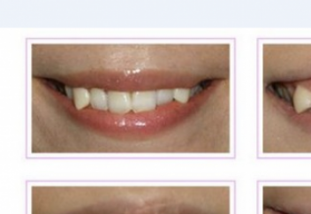 Ақыл тісті жұлу қажет пе?