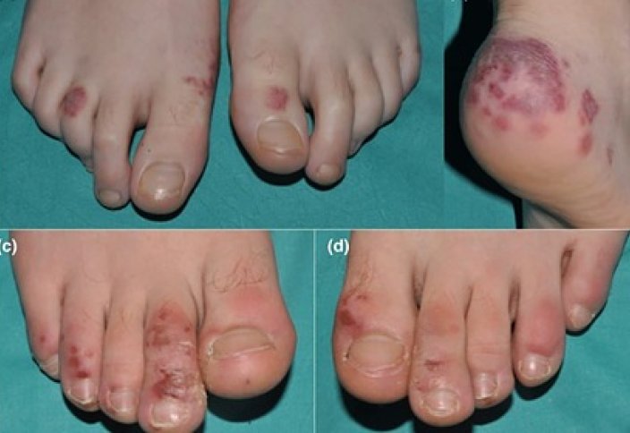 COVID-19: Нетипичный симптом коронавируса показали на фотографиях