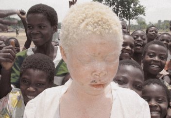 Қараңғылықтың, саясаттың құрбаны болған альбиностар өздерін қорғауды сұрап, мұң-зарын жеткізді