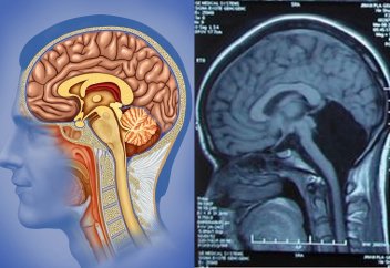 24 жыл бойы мишықсыз өмір сүріп келген