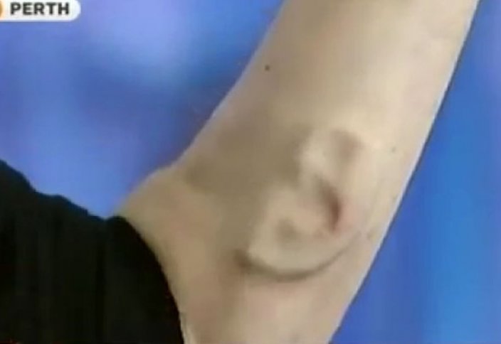 Өз денесінде үшінші құлақ өсірді