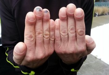 Қазақстанда 80 адам муковисцидоз дертіне шалдыққан