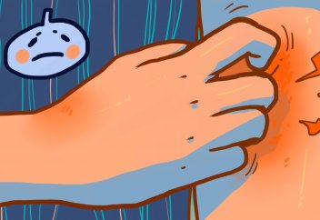 Стрестен экзема пайда болады