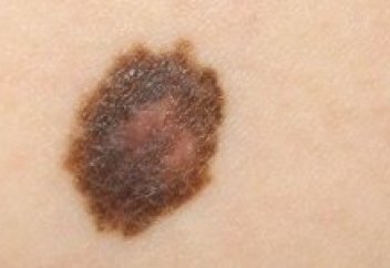 Қатерлі ісіктің даму барысын болжайтын модел жасалды