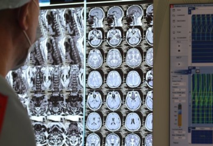 Как лечат пациентов с самой распространенной опухолью мозга в Президентской клинике