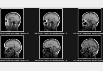 Бас сақинасын қалай емдеуге болады