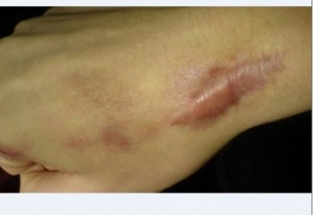 Тыртықтан арылу жолдары