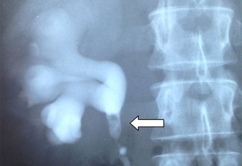 Отандық дәрігерлер бүйректегі тасты алудың жаңа әдісін енгізді