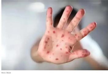 Қызылша өршіп тұр: Қырғызстанда жыл басынан бері тоғыз бала қайтыс болды