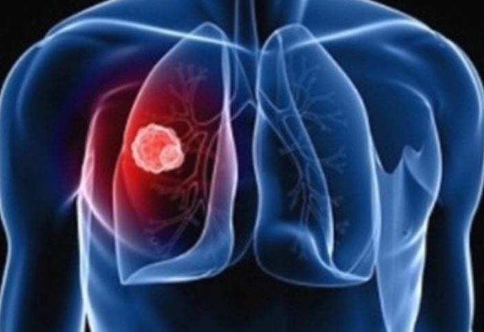 Возвращение белой смерти: угроза возникновения новых штаммов туберкулеза