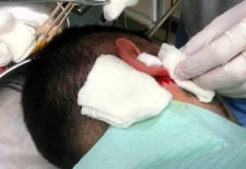 Елімізде тұңғыш рет есту қабілетін қалпына келтіретін ота жасалды