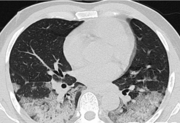 Врачи показали, как коронавирус съедает легкие (видео)