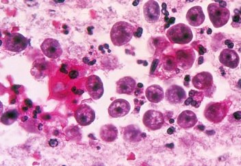 Разные: Поедающая мозг амеба заразила человека во Флориде