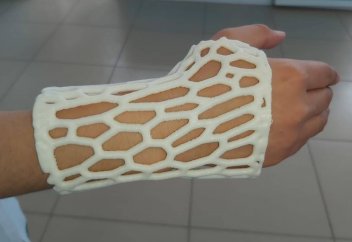 Новые разработки молодых казахстанских ученых: пластиковая альтернатива тяжелому гипсу