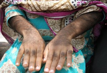 Денесін түк басып кеткен қызды емдеу үшін несие алуға бел байлады (фото)