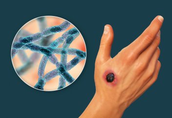 Cібір жарасын антибиотиксіз емдеп жазудың жолы табылды. Антибиотикке қарағанда жарақатты екі есе тез жазатын химикат табылды