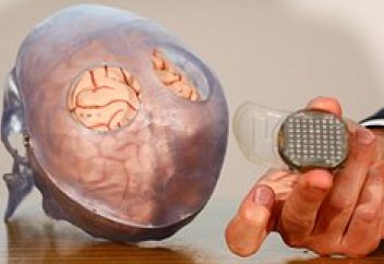 Ми имплантының негізгі зияны айтылды