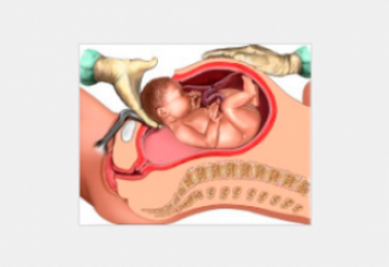 Женщинам так часто делают кесарево сечение, что это начинает влиять на эволюцию