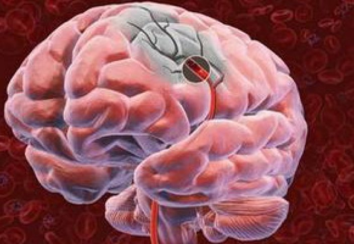 Опухоль мозга вылечат с помощью вируса бешенства