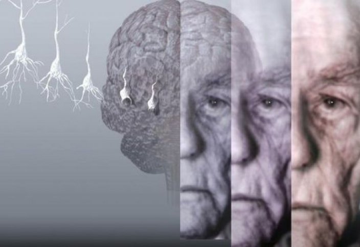 Альцгеймерді емдеудің күтпеген тәсілі табылды