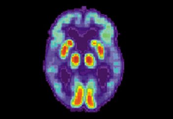 Тәжірибе жүргізілген дәрі Альцгеймер ауруы симптомының алдын алды