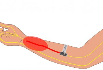 Ауруды басатын биоимплант денеде еріп, денеге сіңіп кетеді (видео)