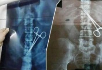 Қажының ішінен қайшы табылды