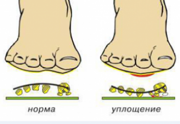 ПЛОСКОСТОПИЕ СИМПТОМЫ И ЛЕЧЕНИЕ (ФОТО, ВИДЕО)