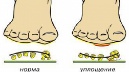 ПЛОСКОСТОПИЕ СИМПТОМЫ И ЛЕЧЕНИЕ (ФОТО, ВИДЕО)