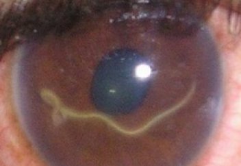 Соқырлыққа бастауы мүмкін қауіпті паразит табылды