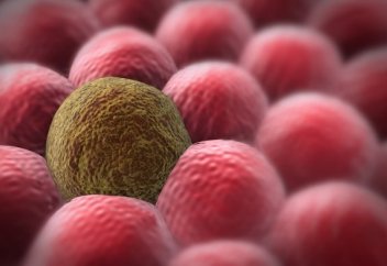 Белгілі бір ультрадыбыс жиілігімен обыр жасушаларын жоюға болатын тәсіл