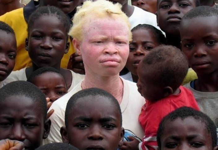 Защитить альбиносов намерены мусульмане Малави