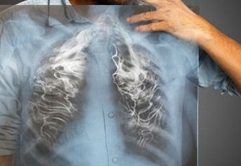 Коронавирус кезінде өкпе қалай зақымданады? Коронавирустың тағы бір жаңа белгісі анықталды