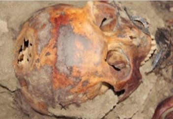 Қазақтар VIII ғасырда ота жасай білген